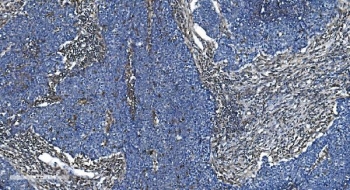 IHC staining of FFPE human lung cancer with GNG2 antibody. HIER: boil tissue sections in pH8 EDTA for 20 min and allow to cool before testing.