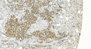IHC staining of FFPE human renal carcinoma with LSM5 antibody. HIER: boil tissue sections in pH8 EDTA for 20 min and allow to cool before testing.