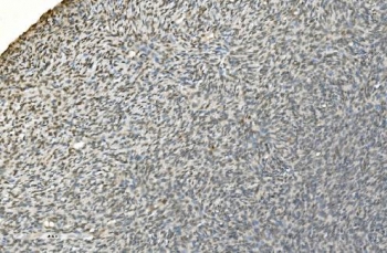 IHC staining of FFPE human skin cancer with LSM7 antibody. HIER: boil tissue sections in pH8 EDTA for 20 min and allow to cool before testing.