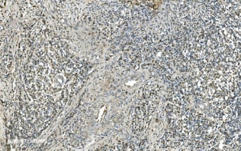 IHC staining of FFPE human gastric cancer with LSM7 antibody. HIER: boil tissue sections in pH8 EDTA for 20 min and allow to cool before testing.