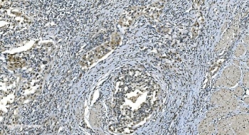 IHC staining of FFPE human bladder cancer with LSM8 antibody. HIER: boil tissue sections in pH8 EDTA for 20 min and allow to cool before testing.