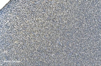 IHC staining of FFPE human skin cancer with LSM8 antibody. HIER: boil tissue sections in pH8 EDTA for 20 min and allow to cool before testing.