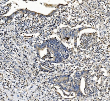 IHC staining of FFPE human rectal cancer with NDUFB2 antibody. HIER: boil tissue sections in pH8 EDTA for 20 min and allow to cool before testing.