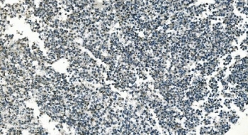 PI16 / Peptidase inhibitor 16 antibody in human testicular cancer by immunohistochemistry. Formalin-fixed paraffin-embedded human testicular cancer tissue stained with PI16 antibody shows cytoplasmic HRP-DAB chromogenic signal in tumor cells. Positive cells display granular cytoplasmic staining within the tumor cell population. Heat induced epitope retrieval was performed by boiling tissue sections in pH 8 EDTA buffer for 20 minutes followed by cooling prior to antibody incubation.