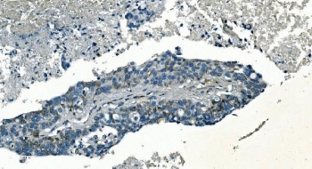 PI16 Antibody in human pancreatic cancer by immunohistochemistry. Formalin-fixed paraffin-embedded human pancreatic cancer tissue stained with PI16 / Peptidase inhibitor 16 antibody shows cytoplasmic HRP-DAB chromogenic signal in tumor epithelial cells within the malignant glandular structures. Positive cells display granular cytoplasmic staining, while surrounding stromal elements show weaker or minimal signal. Heat induced epitope retrieval was performed by boiling tissue sections in pH 8 EDTA buffer for 20 minutes followed by cooling prior to antibody incubation.