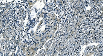 PI16 Antibody in human bladder cancer by immunohistochemistry. Formalin-fixed paraffin-embedded human bladder cancer tissue stained with PI16 / Peptidase inhibitor 16 antibody shows HRP-DAB chromogenic staining in tumor epithelial cells and surrounding stromal components. Positive cells display cytoplasmic signal within malignant epithelial nests embedded in fibrous stroma, while adjacent stromal cells exhibit variable staining intensity. Heat induced epitope retrieval was performed by boiling tissue sections in pH 8 EDTA buffer for 20 minutes followed by cooling prior to antibody incubation.