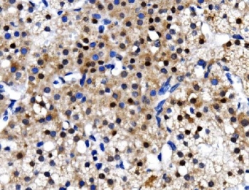 IHC staining of FFPE human renal carcinoma with TBP-1 antibody. HIER: boil tissue sections in pH8 EDTA for 20 min and allow to cool before testing.
