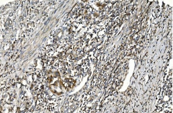 IHC staining of FFPE human bladder cancer with gp91phox antibody. HIER: boil tissue sections in pH8 EDTA for 20 min and allow to cool before testing.