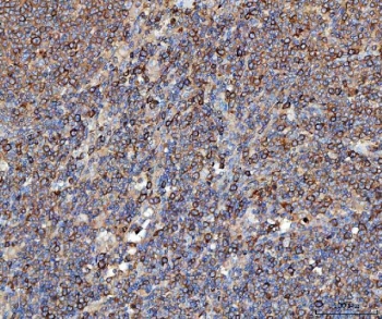 IHC staining of FFPE human lymphoma with Elongation Factor 2 antibody. HIER: boil tissue sections in pH8 EDTA for 20 min and allow to cool before testing.