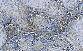 IHC staining of FFPE human esophageal squamous cancer with GABARAP antibody. HIER: boil tissue sections in pH8 EDTA for 20 min and allow to cool before testing.