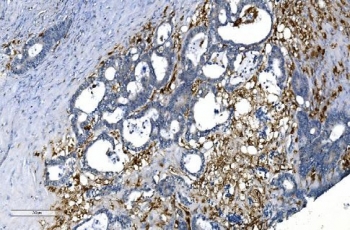 GCHFR Antibody Rectal Cancer IHC. Immunohistochemistry analysis of FFPE human rectal cancer tissue stained with GCHFR Antibody demonstrates granular cytoplasmic HRP-DAB brown staining throughout gland-forming tumor epithelial cellular populations, consistent with expression of GTP cyclohydrolase I feedback regulator / GCHFR in tetrahydrobiopterin-associated metabolic signaling and nitric oxide regulatory pathways. The observed staining pattern aligns with the intracellular metabolic regulatory function of this BH4-associated feedback protein in proliferative epithelial tissue environments. HIER: boil tissue sections in pH 8 EDTA for 20 min and allow to cool before testing.