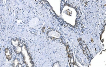 GCHFR Antibody Prostate Cancer IHC. Immunohistochemistry analysis of FFPE human prostate cancer tissue stained with GCHFR Antibody demonstrates cytoplasmic HRP-DAB brown staining within glandular tumor epithelial cellular populations, consistent with the role of GTP cyclohydrolase I feedback regulator / GCHFR in tetrahydrobiopterin metabolism and nitric oxide-associated metabolic regulation pathways. The observed staining profile aligns with the intracellular cofactor regulatory biology of GCHFR within epithelial-associated tissue compartments. HIER: boil tissue sections in pH 8 EDTA for 20 min and allow to cool before testing.