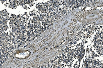 IHC staining of FFPE human testicular cancer with GNG7 antibody. HIER: boil tissue sections in pH8 EDTA for 20 min and allow to cool before testing.