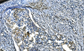 IHC staining of FFPE human bladder cancer with UBE2D1/2/3/4 antibody. HIER: boil tissue sections in pH8 EDTA for 20 min and allow to cool before testing.
