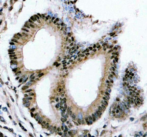 YTHDC1 Antibody Human Colon Adenocarcinoma IHC. Immunohistochemical analysis of YTHDC1 Antibody / Nuclear m6A Reader Protein Antibody in FFPE human colon adenocarcinoma tissue. Following heat-induced epitope retrieval in pH 8.0 EDTA buffer, sections were stained with YTHDC1 antibody at 2 ug/ml and detected using an HRP-conjugated secondary antibody with DAB chromogen. Distinct nuclear staining is observed in the neoplastic glandular epithelial cells, consistent with the predominantly nuclear localization of YTHDC1 as an m6A RNA reader involved in RNA processing and gene expression. This YTHDC1 Antibody, a Nuclear m6A Reader Protein Antibody, is well suited for studies of epitranscriptomic regulation and YTHDC1 expression in colorectal cancer.