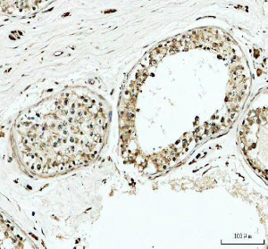YTHDC1 Antibody Human Testicular Cancer IHC. Immunohistochemical analysis of YTHDC1 Antibody / Nuclear m6A Reader Protein Antibody in FFPE human testicular cancer tissue. Following heat-induced epitope retrieval in pH 8.0 EDTA buffer, sections were stained with YTHDC1 antibody at 2 ug/ml and detected using an HRP-conjugated secondary antibody with DAB chromogen. Predominantly nuclear staining is observed in the neoplastic cells, with weaker cytoplasmic staining in some areas, consistent with the primary nuclear localization of YTHDC1 and its role as an m6A RNA reader involved in RNA processing and gene regulation. This YTHDC1 Antibody, a Nuclear m6A Reader Protein Antibody, is well suited for investigating epitranscriptomic regulation and YTHDC1 expression in testicular cancer tissues.