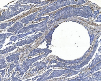 IHC staining of FFPE human esophageal squamous carcinoma with FLNA antibody. HIER: boil tissue sections in pH8 EDTA for 20 min and allow to cool before testing.