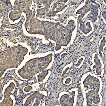IHC staining of FFPE human breast cancer with ALDOA antibody. HIER: boil tissue sections in pH8 EDTA for 20 min and allow to cool before testing.
