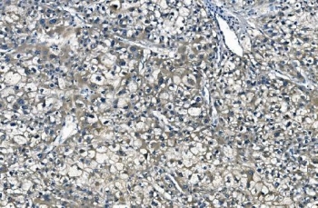 IHC staining of FFPE human liver cancer with ASS1 antibody. HIER: boil tissue sections in pH8 EDTA for 20 min and allow to cool before testing.