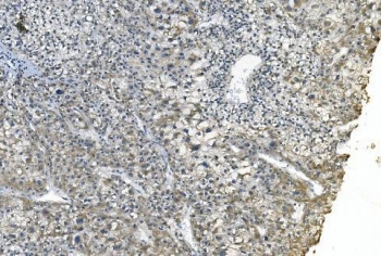 IHC staining of FFPE human liver cancer with eRF1 antibody. HIER: boil tissue sections in pH8 EDTA for 20 min and allow to cool before testing.
