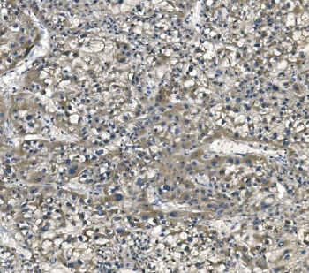 IHC staining of FFPE human liver cancer with EFT1 antibody. HIER: boil tissue sections in pH8 EDTA for 20 min and allow to cool before testing.