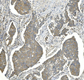 IHC staining of FFPE human breast cancer with EEF2 antibody. HIER: boil tissue sections in pH8 EDTA for 20 min and allow to cool before testing.
