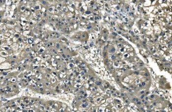 IHC staining of FFPE human liver cancer with ANPEP antibody. HIER: boil tissue sections in pH8 EDTA for 20 min and allow to cool before testing.