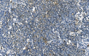 IHC staining of FFPE human lung cancer with CA1 antibody. HIER: boil tissue sections in pH8 EDTA for 20 min and allow to cool before testing.