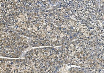 IHC staining of FFPE human liver cancer with CA1 antibody. HIER: boil tissue sections in pH8 EDTA for 20 min and allow to cool before testing.