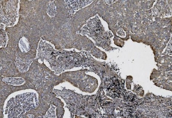 IHC staining of FFPE human lung cancer with Cadherin 2 antibody. HIER: boil tissue sections in pH8 EDTA for 20 min and allow to cool before testing.