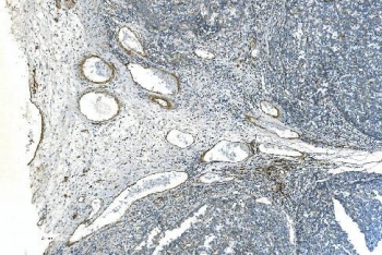 IHC staining of FFPE human melanoma with Cadherin 13 antibody. HIER: boil tissue sections in pH8 EDTA for 20 min and allow to cool before testing.