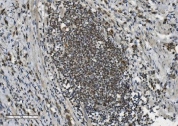 PARP1 Antibody Stomach Adenocarcinoma IHC. Immunohistochemistry analysis of FFPE human poorly differentiated stomach adenocarcinoma tissue using PARP1 antibody. Tumor cell nuclei demonstrate strong HRP-DAB brown staining consistent with the chromatin-associated localization of PARP1 in DNA repair, genomic instability adaptation, and nuclear stress-response signaling pathways active in poorly differentiated gastric carcinoma tissue. Nuclei are counterstained blue. Heat-induced epitope retrieval was performed by boiling tissue sections in pH8 EDTA buffer for 20 minutes followed by cooling prior to staining.