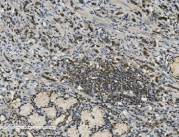 PARP1 Antibody Diffuse Gastric Adenocarcinoma IHC. Immunohistochemistry analysis of FFPE human poorly differentiated stomach adenocarcinoma tissue using PARP1 antibody. Tumor cell nuclei demonstrate widespread HRP-DAB brown staining consistent with the chromatin-associated activity of PARP1 in DNA strand break repair, genomic maintenance, and nuclear stress-response signaling pathways within aggressive gastric carcinoma tissue. Nuclei are counterstained blue. Heat-induced epitope retrieval was performed by boiling tissue sections in pH8 EDTA buffer for 20 minutes followed by cooling prior to staining.