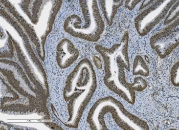 PARP1 Antibody Rectal Cancer IHC. Immunohistochemistry analysis of FFPE human rectal cancer tissue using PARP1 antibody. Tumor epithelial cell nuclei demonstrate strong HRP-DAB brown staining consistent with the chromatin-associated localization of PARP1 in DNA repair, genomic surveillance, and cellular stress-response signaling pathways within proliferative colorectal carcinoma tissue. Nuclei are counterstained blue. Heat-induced epitope retrieval was performed by boiling tissue sections in pH8 EDTA buffer for 20 minutes followed by cooling prior to staining.