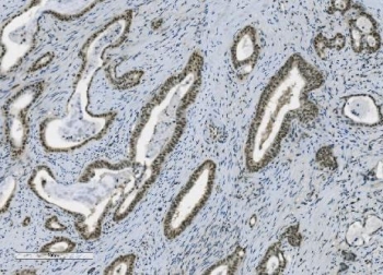 PARP1 Antibody Gallbladder Adenocarcinoma IHC. Immunohistochemistry analysis of FFPE human gallbladder adenocarcinoma tissue using PARP1 antibody. Tumor epithelial cell nuclei demonstrate strong HRP-DAB brown staining consistent with the chromatin-associated localization of PARP1 in DNA repair, genomic stability maintenance, and nuclear stress-response signaling pathways within gland-forming biliary carcinoma tissue. Nuclei are counterstained blue. Heat-induced epitope retrieval was performed by boiling tissue sections in pH8 EDTA buffer for 20 minutes followed by cooling prior to staining.