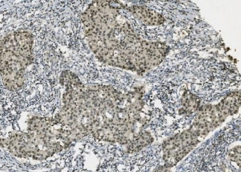 PARP1 Antibody Breast Cancer IHC. Immunohistochemistry analysis of FFPE human breast cancer tissue using PARP1 antibody. Tumor cell nuclei demonstrate diffuse HRP-DAB brown staining consistent with the chromatin-associated activity of PARP1 in DNA repair, genomic stability maintenance, and nuclear stress-response signaling pathways within proliferative breast carcinoma tissue. Nuclei are counterstained blue. Heat-induced epitope retrieval was performed by boiling tissue sections in pH8 EDTA buffer for 20 minutes followed by cooling prior to staining.