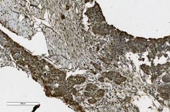 Poly (ADP-ribose) polymerase 1 Antibody Ovarian Serous Adenocarcinoma IHC. Immunohistochemistry staining of FFPE human ovarian serous adenocarcinoma with Poly (ADP-ribose) polymerase 1 antibody. HIER: boil tissue sections in pH8 EDTA for 20 min and allow to cool before testing.