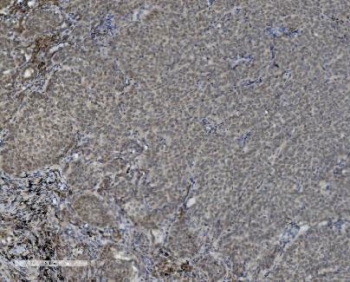PARP1 Antibody Lung Cancer IHC. Immunohistochemistry staining of FFPE human lung cancer with PARP1 antibody. HIER: boil tissue sections in pH8 EDTA for 20 min and allow to cool before testing.