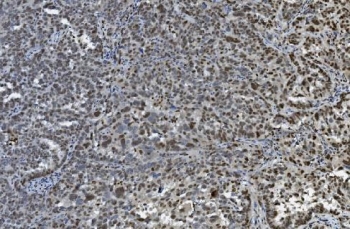 IHC staining of FFPE human ovarian cancer with TKT antibody. HIER: boil tissue sections in pH8 EDTA for 20 min and allow to cool before testing.