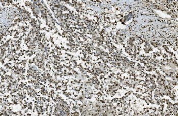 IHC staining of FFPE human pancreatic cancer with TKT antibody. HIER: boil tissue sections in pH8 EDTA for 20 min and allow to cool before testing.