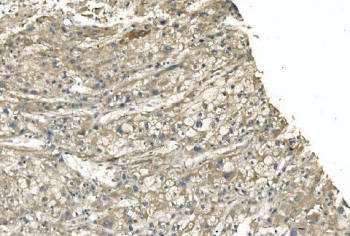IHC staining of FFPE human liver cancer with TUBA1 antibody. HIER: boil tissue sections in pH8 EDTA for 20 min and allow to cool before testing.