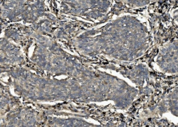 IHC staining of FFPE human lung cancer with CASP7 antibody. HIER: boil tissue sections in pH8 EDTA for 20 min and allow to cool before testing.
