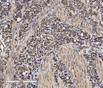 IHC staining of FFPE human gastric cancer with VPRBP antibody. HIER: boil tissue sections in pH8 EDTA for 20 min and allow to cool before testing.