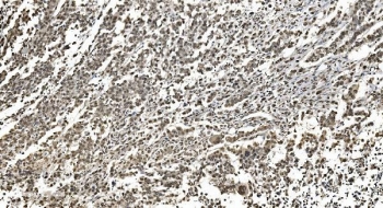 IHC staining of FFPE human pancreatic cancer with hnRNP H3 antibody. HIER: boil tissue sections in pH8 EDTA for 20 min and allow to cool before testing.