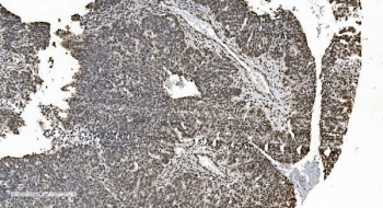 IHC staining of FFPE human ovarian serous adenocarcinoma with hnRNP H3 antibody. HIER: boil tissue sections in pH8 EDTA for 20 min and allow to cool before testing.