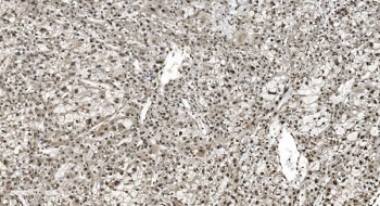 IHC staining of FFPE human liver cancer with hnRNP H3 antibody. HIER: boil tissue sections in pH8 EDTA for 20 min and allow to cool before testing.