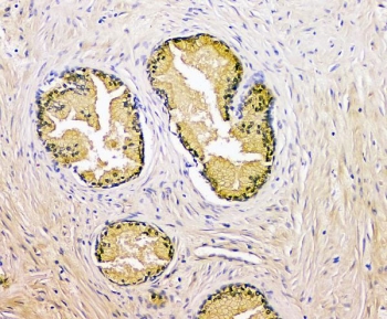 PSA Antibody Rabbit Polyclonal IHC staining of human prostate cancer. Immunohistochemistry analysis of FFPE human prostate carcinoma using PSA Antibody Rabbit Polyclonal shows strong HRP-DAB brown cytoplasmic staining in malignant glandular epithelial cells, consistent with Prostate specific antigen (KLK3) expression in prostate-derived tumor cells, while surrounding stromal cells remain largely negative. HIER: tissue sections were boiled in pH 8 EDTA buffer for 20 minutes and allowed to cool before testing.