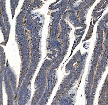 Immunohistochemistry of Synaptic vesicle glycoprotein 2A antibody in human rectal cancer tissue. FFPE human rectal carcinoma demonstrates cytoplasmic HRP-DAB brown staining within tumor epithelial cells, with membranous accentuation in gland-forming regions, consistent with SV2A localization in vesicular and secretory compartments. Heat-induced epitope retrieval was performed by boiling tissue sections in pH 8 EDTA for 20 minutes followed by cooling prior to staining.