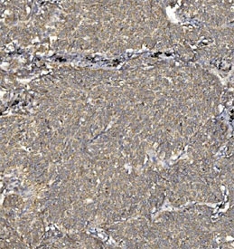 IHC staining of FFPE human lung cancer tissue with Synaptic vesicle glycoprotein 2A antibody. HIER: boil tissue sections in pH8 EDTA for 20 min and allow to cool before testing.