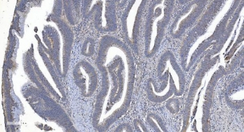 IHC staining of FFPE human rectal cancer tissue with ARG2 antibody. HIER: boil tissue sections in pH8 EDTA for 20 min and allow to cool before testing.